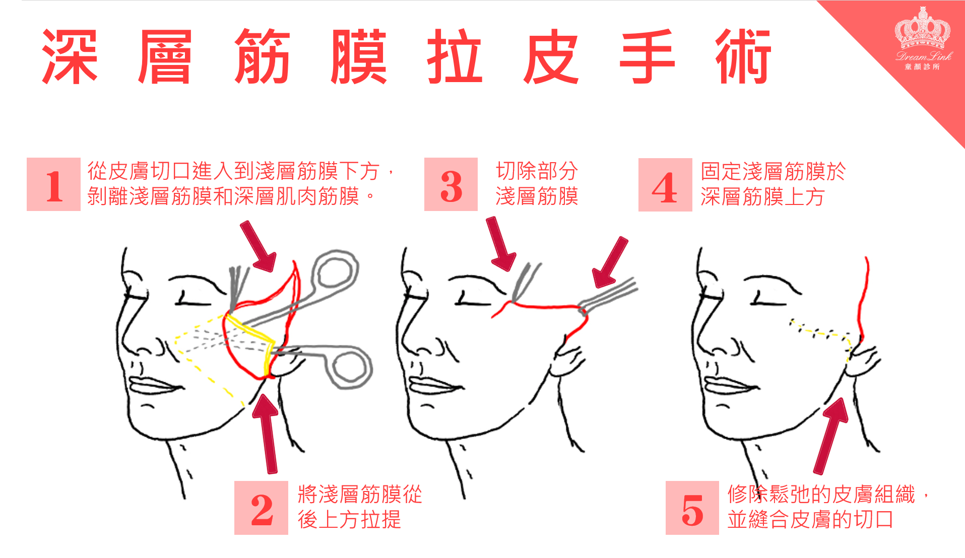 深層筋膜拉皮